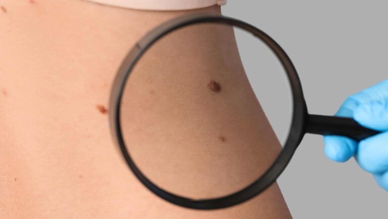 Inteligência artificial detecta câncer de pele com precisão inédita