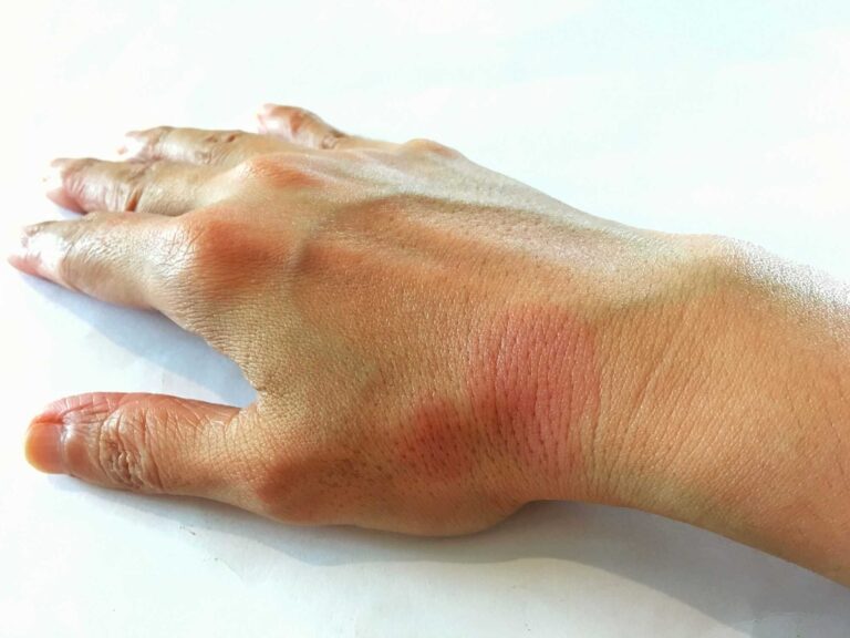 Estudo revela que vírus comum pode desencadear lúpus