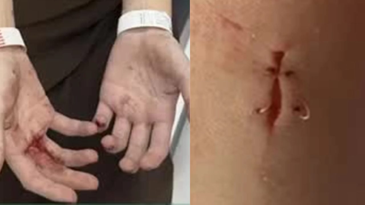 Atriz da Globo mostra ferimentos após assalto em São Paulo