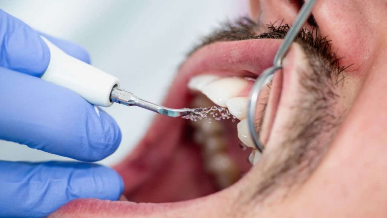 Plaque remover close-up