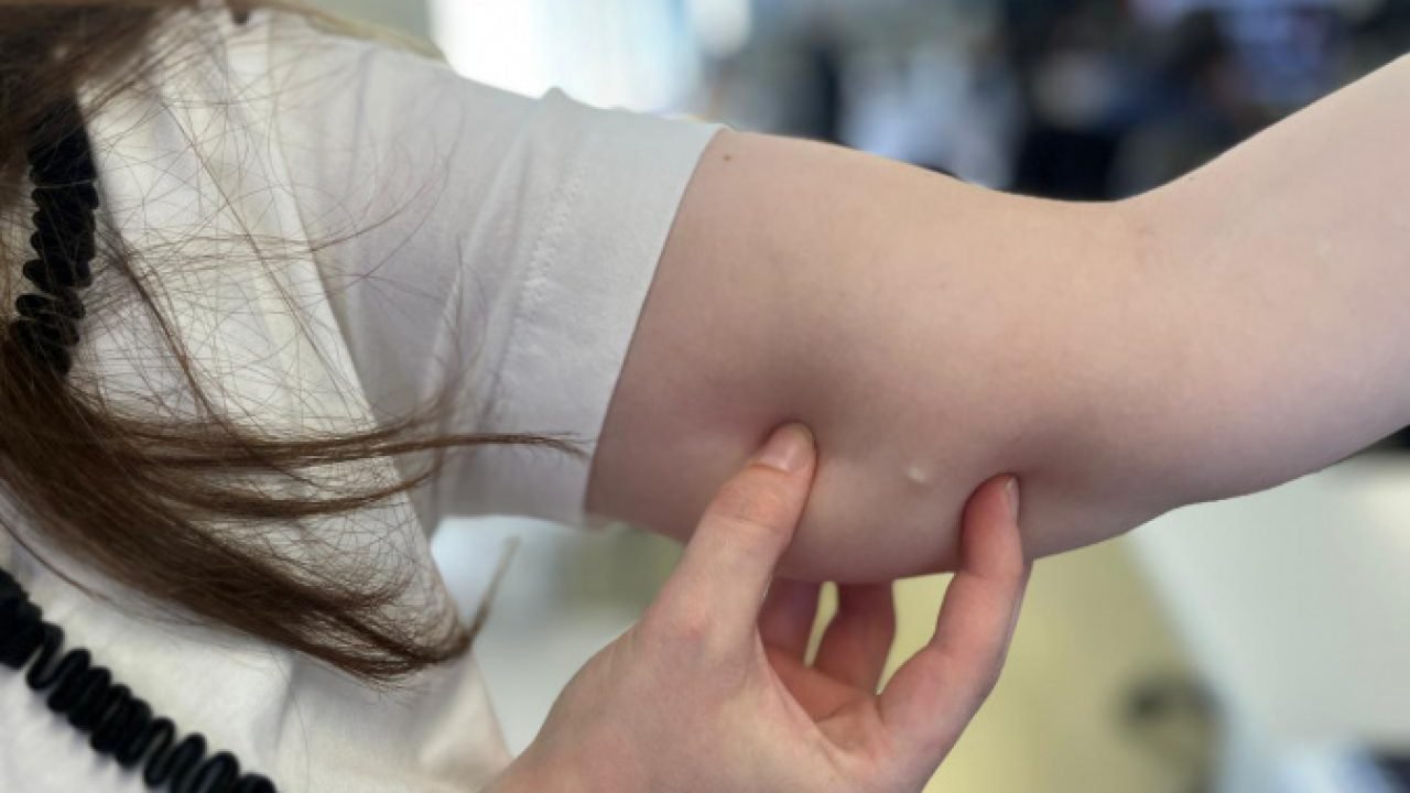 Procura por implante contraceptivo cresce 118% no SUS do Paraná em 2025